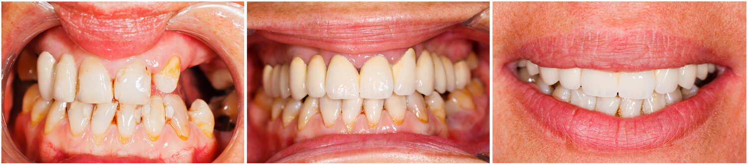 Dental Bridges - Dr Ajay Mehta, DDS | Implants & Dental Care